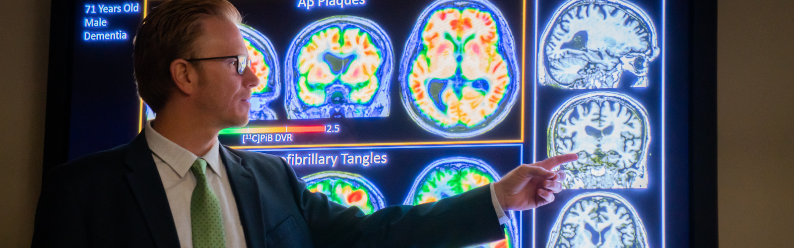 Scans showing dementia in the brain of a 71 year old male